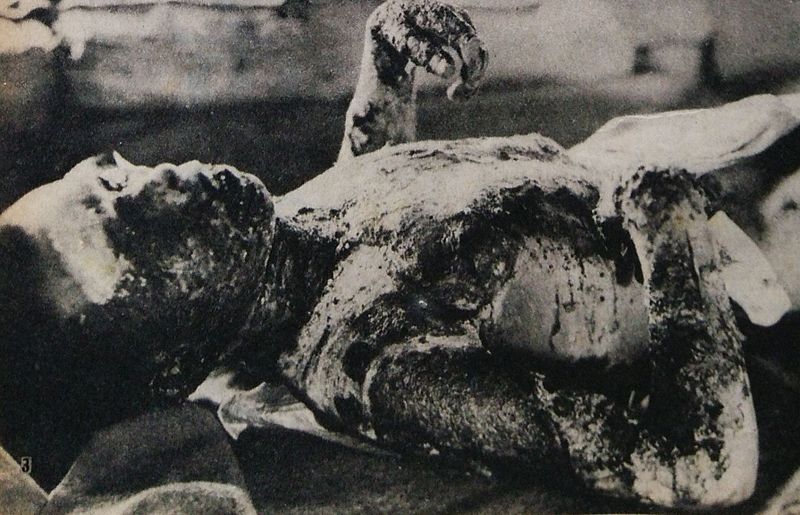 Victim_of_Hiroshima_atomic_bombing_3